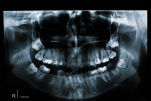 Dental X-Ray